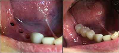 インプラント症例集 3歯欠損 症例